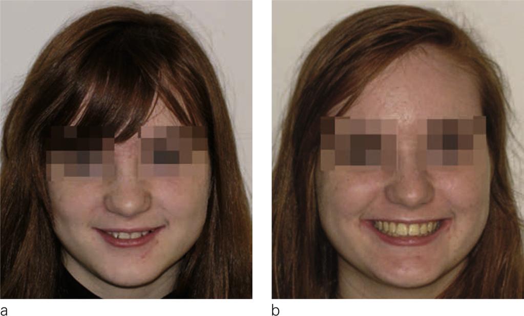 TREATMENT OF CLASS II NON-EXTRACTION USING THE BIOPROGRESSIVE METHOD while smiling and with full lips thanks to incisor torque