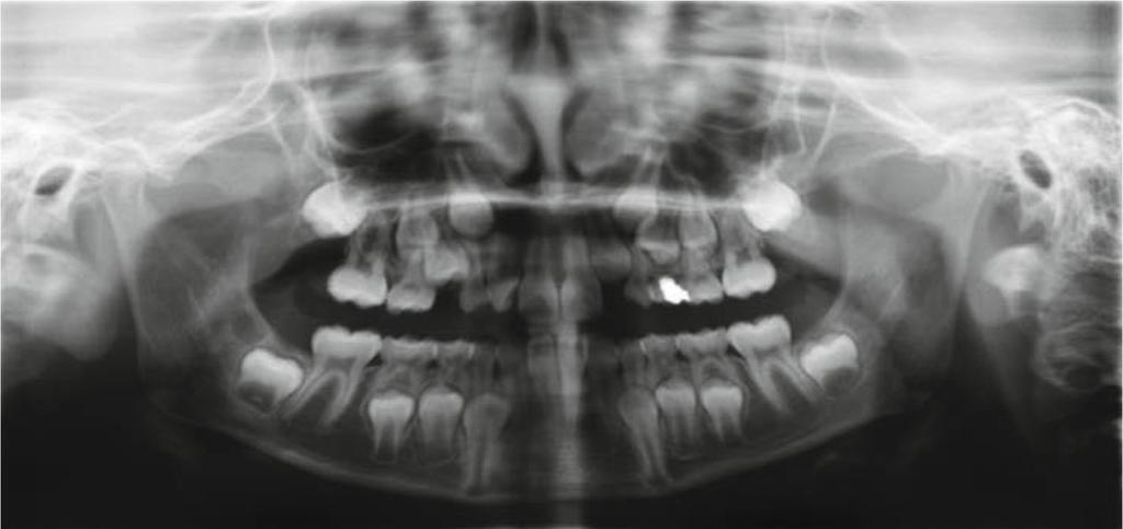 P. GUEZENEC Figure 1 Panoramic radiograph 1st consultation 9 years 3 months. The dental exam shows a bilateral half-step Class II, 23 is impacted. The overjet measures 3 mm with a 90% overbite.