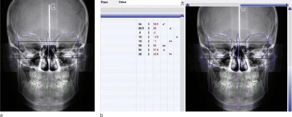TREATMENT OF CLASS II NON-EXTRACTION USING THE BIOPROGRESSIVE METHOD Treatment plan Hilgers pendulum for retraction of 16 and 26 and transverse directional control Molar anchorage using an upper base