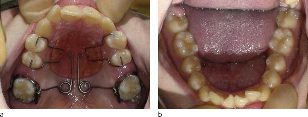 10 bonding of lingual buttons on 24 25 to correct rotation of the premolars. 04.11.10: request for exposure of 23 and extraction of the wisdom teeth. Figure 9 a, b, and c: Intraorals after 6 months.