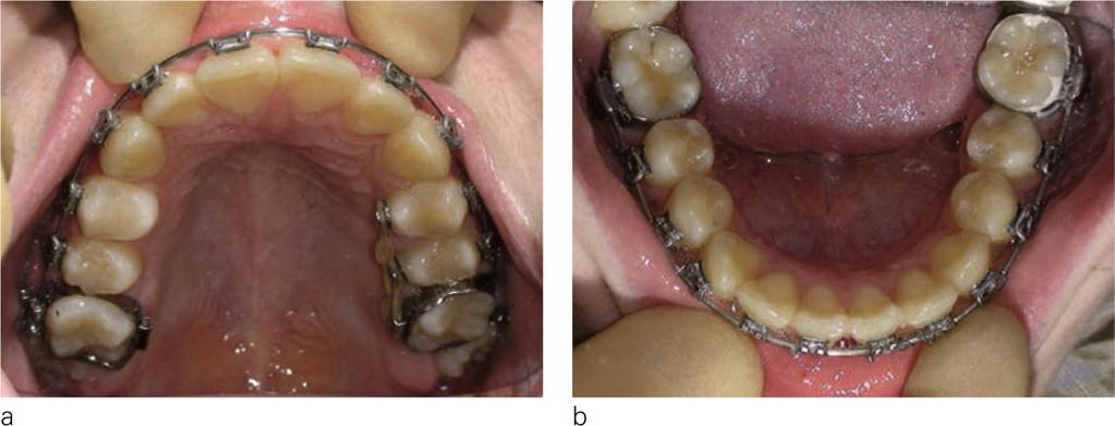 Figure 15 a and b: Maxillary and mandibular