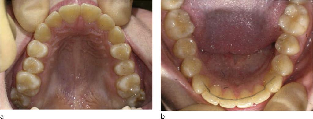 TREATMENT OF CLASS II NON-EXTRACTION USING THE BIOPROGRESSIVE METHOD Figure 17 a and b: Maxillary and mandibular arches at the end of treatment after 30 months.