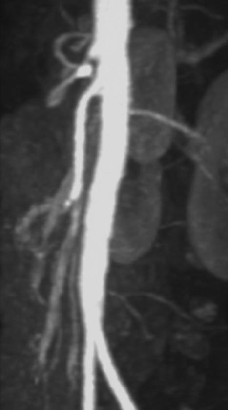 coeliac artery stenosis in APS 27