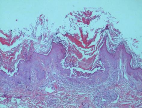 2 Case Reports in Dermatological Medicine Figure 1: Epidermis with acanthosis premature keratosis and suprabasal acantholysis.