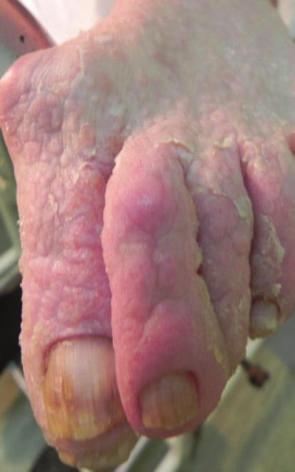 histiocytosis, or severe AD. Histopathologically, the biopsy revealed the presence of epidermis with acanthosis premature keratosis and suprabasal acantholysis.