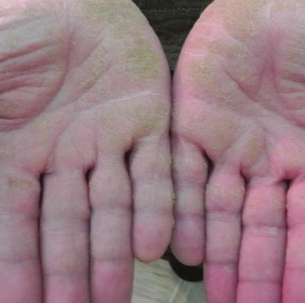 Case Reports in Dermatological Medicine 3 Figure 4: Similar papules were present on the back of her hands and feet.