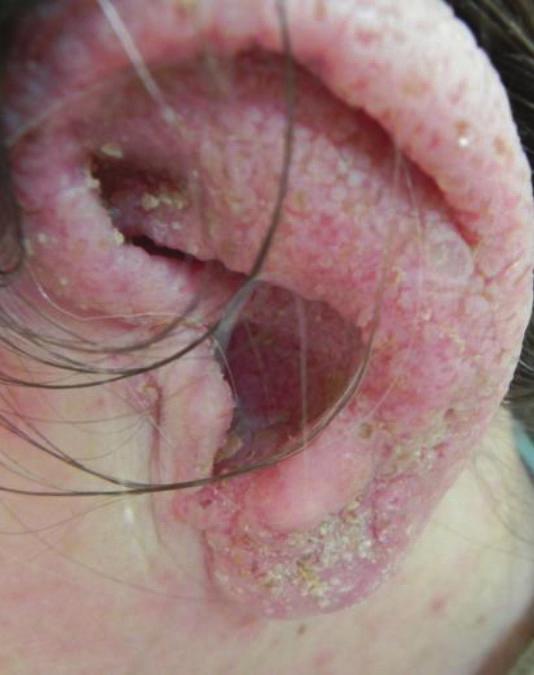 Oral lesions are detected in approximately 15% of the patients, and they appear as white papules with a central depression [12].