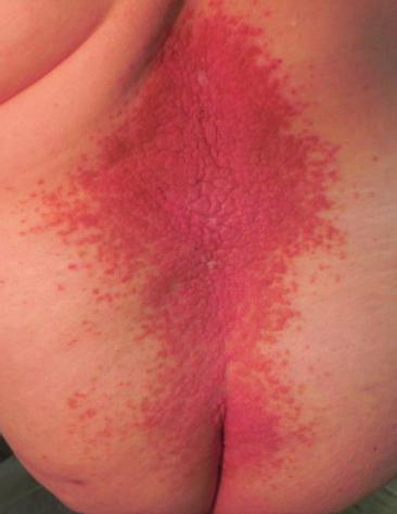 4 Case Reports in Dermatological Medicine Figure 8: Oral lesions are detected as white papules with a central depression. Figure6:Keratoticpapulesarepresentonlowerback.