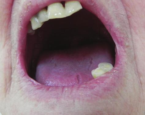 Although the present case is not a severe form of Darier s disease, most patients with severe form of Darier s disease should receive genetic counseling, including information of inherited condition