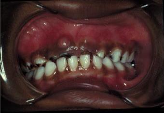 Early Childhood Caries (ECC) ECC: > 1 decayed, missing, or filled tooth