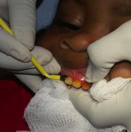Fluoride Varnish Most extensive literature of PCP based preventive strategies Nearly all