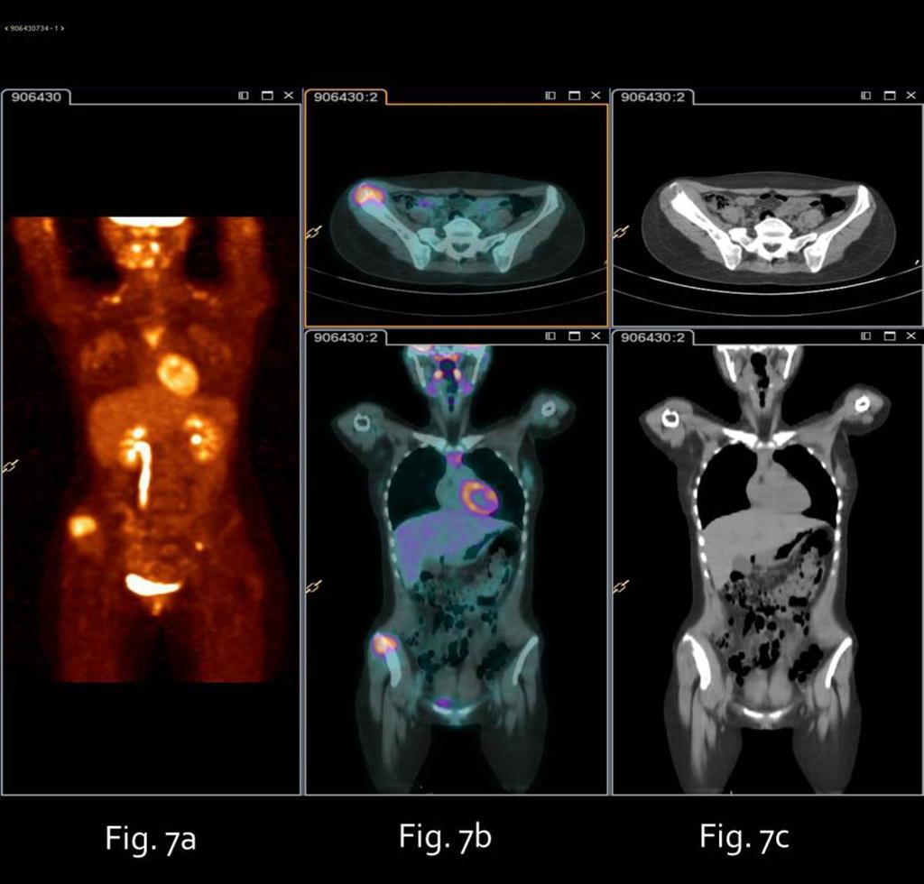 Fig. 7: Ewing sarcoma of right iliac wing. FDG CT-PET shows increased uptake in the right iliac wing: Fig.