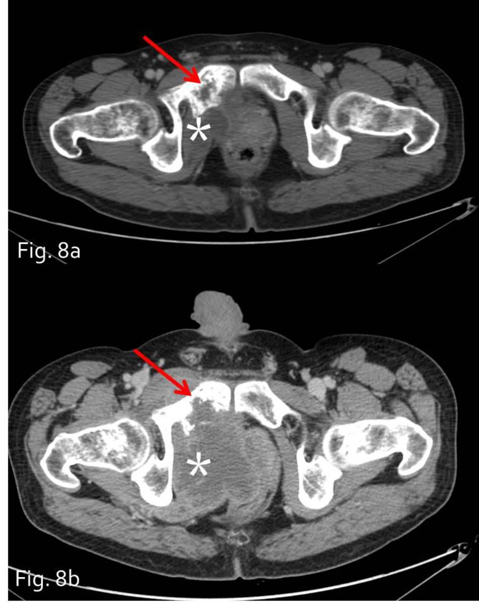 Fig. 8: Ewing sarcoma of the superior ramus of the right pubis. Fig.