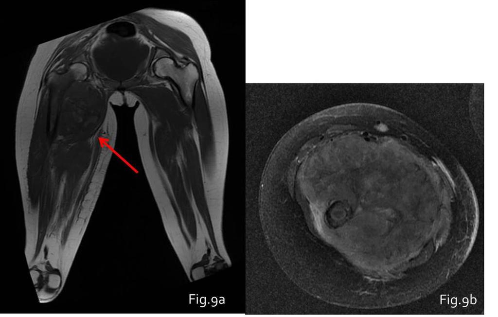 Fig. 9: Ewing sarcoma of the proximal meta-epiphysial region of right femur in a 15 years old girl. MRI images Fig.