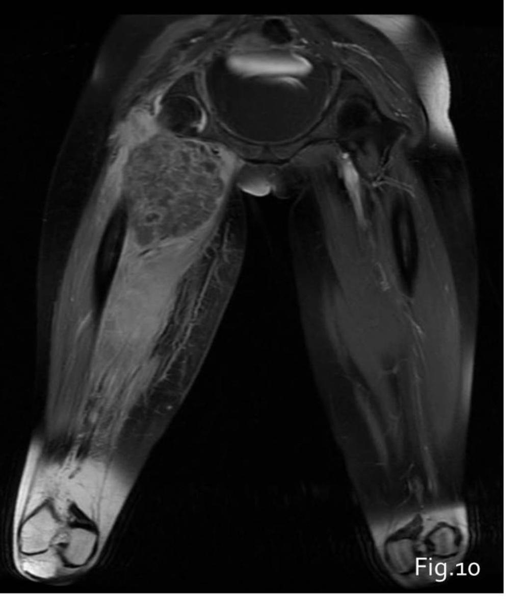 Fig. 10: Same patients as figure 9 Ewing sarcoma of the proximal meta-epiphysial region of right femur in a 15 years old girl.
