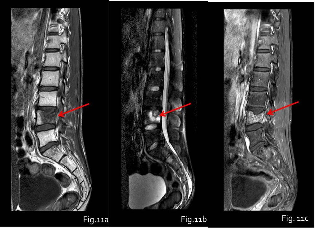 Fig. 11: Post treatment L4 recurrence of a left iliac wing Ewing sarcoma. MR sagittal scans. Fig.