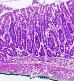 microbiota present IBD Defect in Intestinal barrier 3 2 Trigger via NSAIDs Infections Genetics