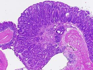 Colon CA in Il10 / Mice Depending on conditions, colon CA developed in 65 95% of mice by 32 wks (0 9 lesions/mouse) cecum IBD in Il10 -/- Mice