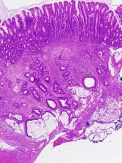 Colon CA in T/I Mice Vagina Rectum Prox colon Locally invasive beyond colon wall but no lymph node metastases.