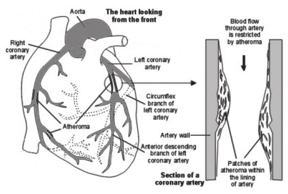 Coronary Arteries Diagnosing Angina In many cases angina is diagnosed from symptoms alone.