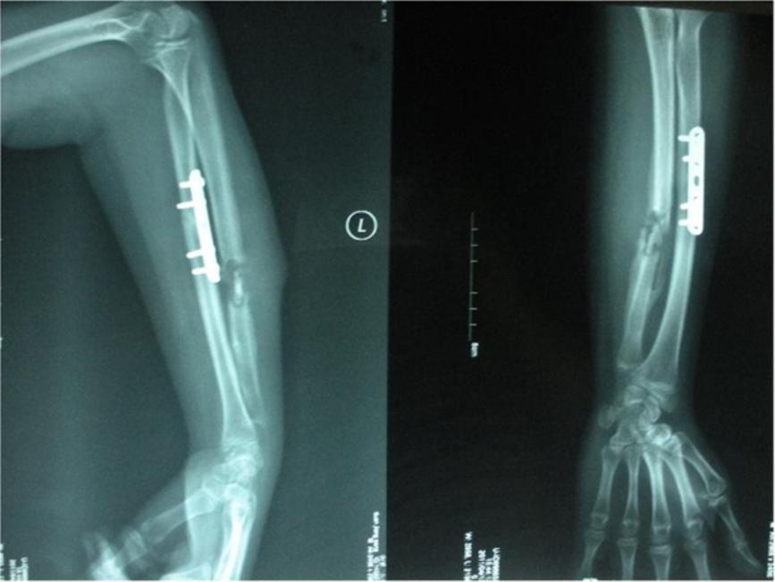 Liu et al. BMC Musculoskeletal Disorders 2013, 14:273 Page 4 of 7 Figure 2 It shows dead bone in the docking site after removal of the ulna internal fixation. The ulna defect was 3.5 cm.