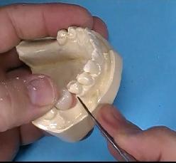 2 Trim tooth to fit space.