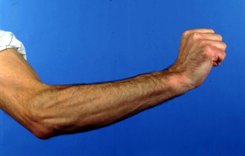Tennis elbow Lateral epicondylitis Common extensor origin