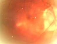 myopic macular hole based on
