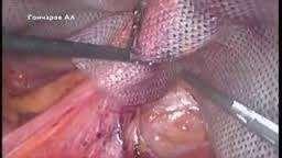 of a large piece of mesh over the entire defect Complete reduction of the hernia sac