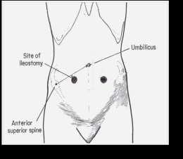 Preoperative stoma siting Can prevent most of the stoma complications The goal is to provide a stoma fit for a tight seal appliance which lasts for 5-7 days The site is marked when the patient is
