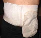 Conservative Treatment The the majority of cases will present with asymptomatic bulge Using an ostomy belt : abdominal