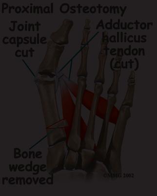 The basic considerations in performing any surgical procedure for hallux valgus are to remove the bunion to realign the bones that make up the big toe to balance the muscles around the joint so the
