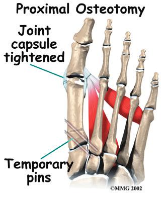 foot. Once the skin is opened the surgeon performs the osteotomy. The bone is then realigned and held in place with metal pins until it heals.