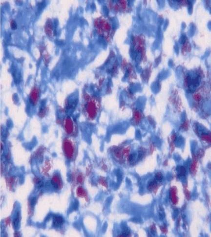 infiltrate dispersed in a necrotic background and raised the suspicion of a tubercular lesion. Ziehl Neelsen stain confirmed presence of acid fast bacilli (Figure 1).