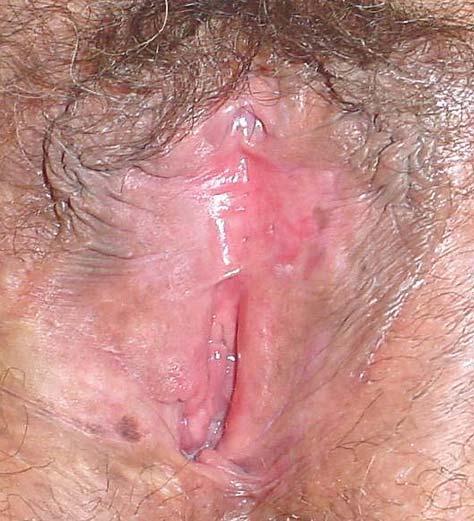 Volume 49, Number 11/November 2004 879 Figure 2 Case 5. Before treatment. White, hyperkeratotic lesions on the inner aspect of both labia minora.