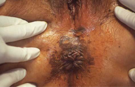 One patient experienced vulvar erosions and the other, vulvar edema. Treatment was resumed up to week 16 and 15, respectively. Erythema occurred in 100% of patients (Figure 1).
