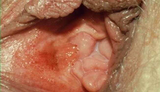 Case 2 A 22 year old women with the vulvar findings pictured, presents with continued dyspareunia.