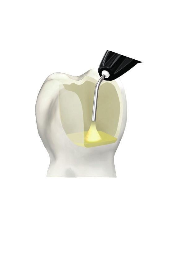 Posterior restorations Cover discoloured dentin by first applying a thin coating