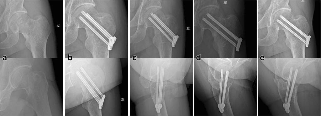 Xiao et al. Journal of Orthopaedic Surgery and Research (2018) 13:131 Page 3 of 8 Fig. 1 A 54-year-old man with a displaced left femoral neck fracture fixed with dynamic compression locking system.