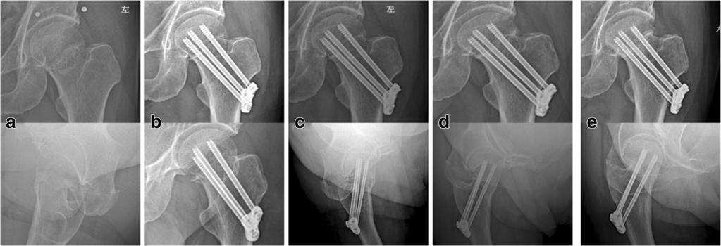 Xiao et al. Journal of Orthopaedic Surgery and Research (2018) 13:131 Page 7 of 8 Fig. 4 Radiograph showing slight screw back-out.