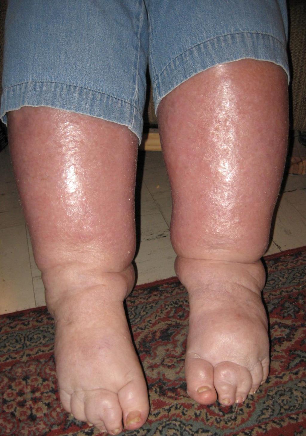 Stasis Dermatitis or Chronic Venous Insuffiency -Bilateral (rare in cellulitis) - Edema + chronic changes -Painful /