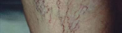 Tl Telangiectasias i Also known as spider veins due to their appearance Very common, especially in women Increase in frequency with age 85% of patients