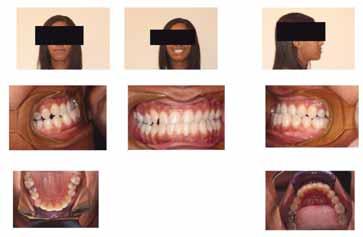 Both patients were treated using the Tip-edge bracket system by Tp Orthodontics. (Fig.
