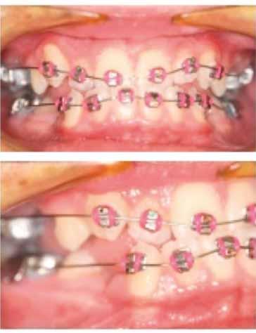 7 Stage I Braces (Fig. 3) Molar tubes on first molars. Bracketed anterior teeth. Upper and lower.016 ss wire with 30 degree bite opening bends, 2 oz. Class III elastics.