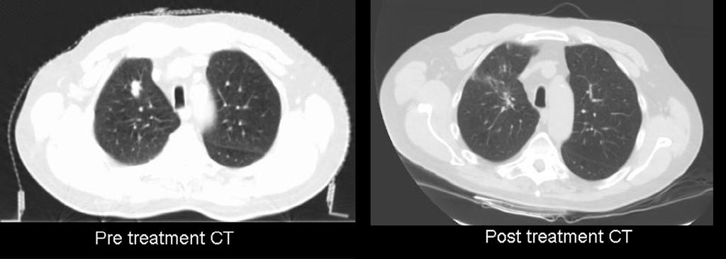 Clinical Applications: NSCLC CT and CT PET scan performed before (left) and after (right) treatment. A complete remission can be seen.