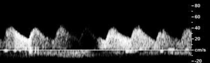 Spectral Doppler - Sweep Speed How to Look at a Waveform?