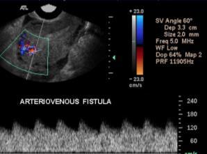 uterine AVM AV Fistulas traumatic AVF