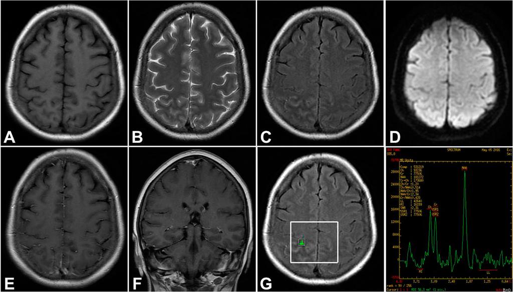 DWI (d). MRI enhancement showed contrast enhancement along the surface of swollen gyrus lesion (e) and (f). MRS showed slightly decreased NAA and increased Cr and Cho peak on the lesion (g) Fig.
