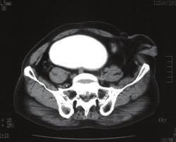 2 Case Reports in Gastrointestinal Medicine (c) (d) Figure 1: Computed tomography (CT) revealed a large cystic mass in the pelvic cavity at our surgical outpatient clinic ((c), (d)) and at another
