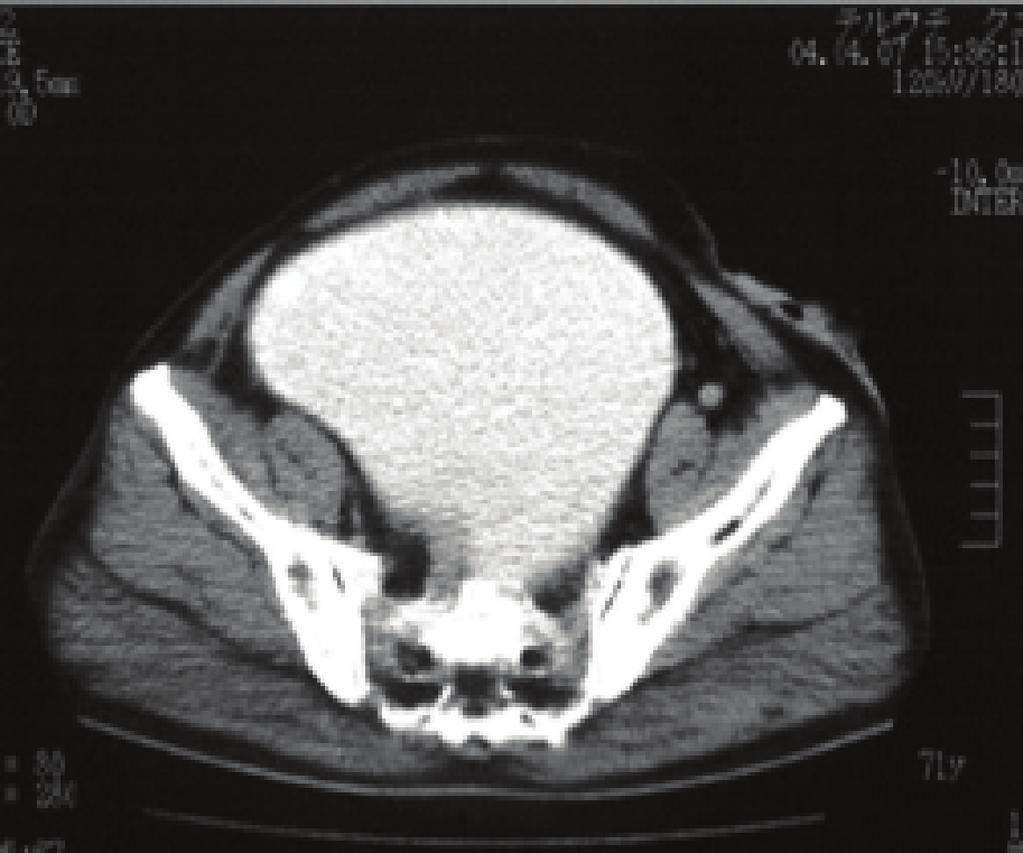 Computed tomography (CT) revealed a large cystic mass measuring 15 12 8 cm in diameter in the lower abdomen (Figures 1(c) and 1(d)).